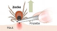 Entfernung von Zecken